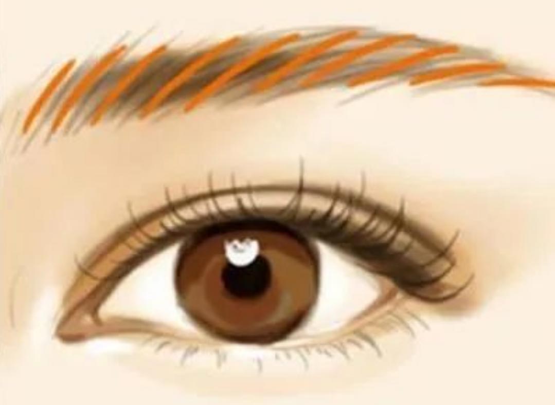 Will Laser Microblading Removal(Eyebrow Tattoo Removal) Leave Scars?