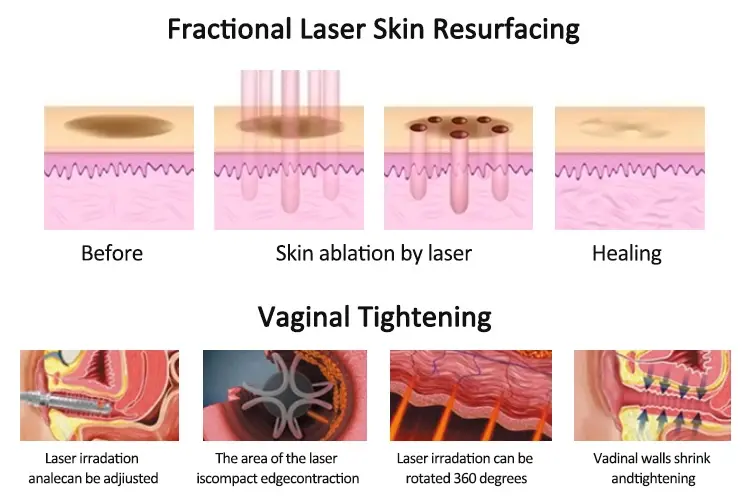 Co2 Fractional Laser Machine