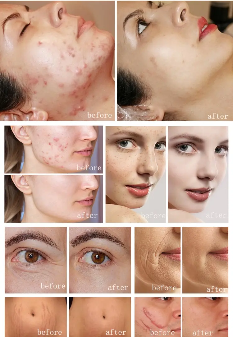 Co2 Skin Treatment Laser
